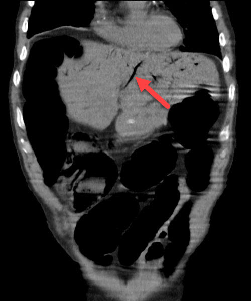 large bowel ischemia coronal CT