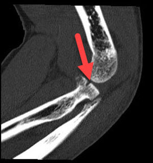 Radial head fracture CT radial head fracture Fat pad sign Pathologic fat pad sign dorsal fat pad sign