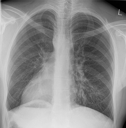 Dextrocardia X-ray, Roentgen