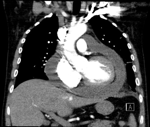 Pericardial Effusion CT coronal
