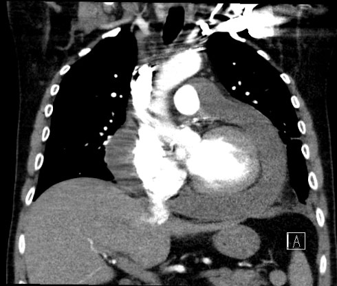 Pericardial Effusion CT coronal image 2