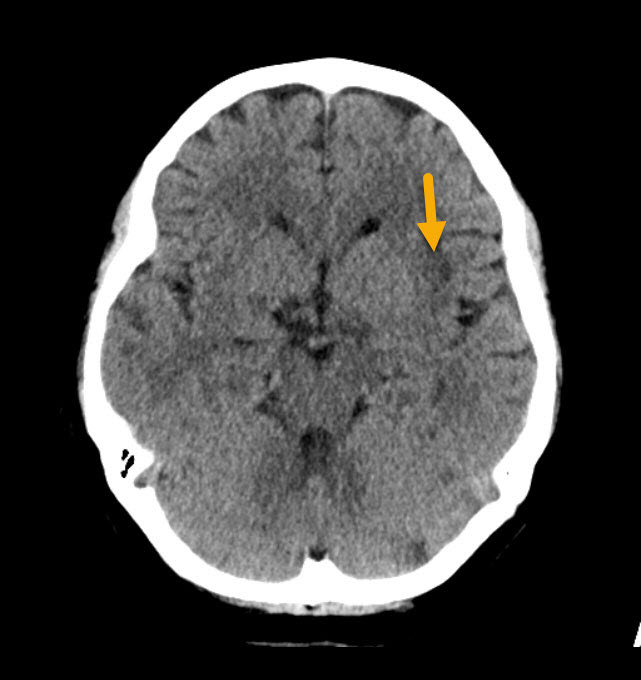 Middle Cerebral Artery Stroke - Radiology For Beginners by Dr. Samuel Kobba