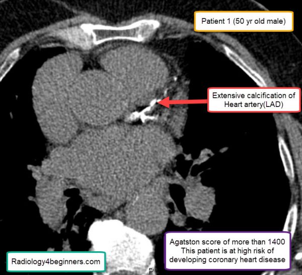 Coronary Calcium Scoring - Radiology For Beginners by Dr. Samuel Kobba