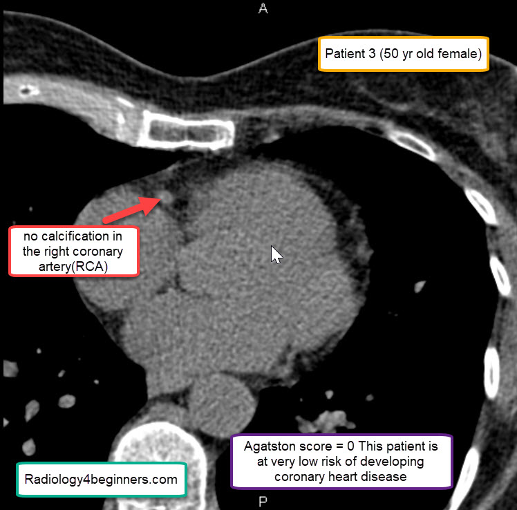 Coronary Calcium Scoring - Radiology For Beginners by Dr. Samuel Kobba