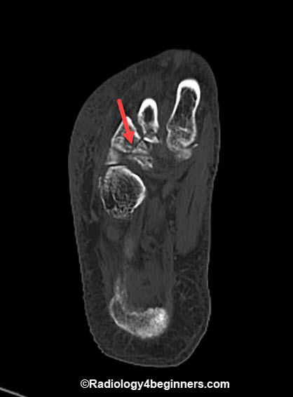 Lis Franc Fracture or Lis Franc Injury(Intraarticular Fracture at the base of the 3rd metatarsal).