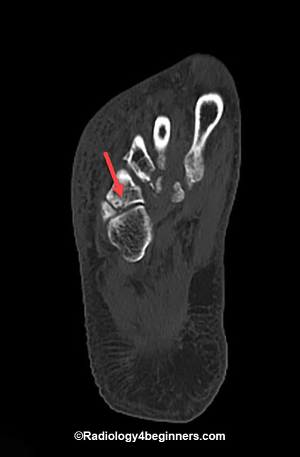 Lis Franc Fracture or Lis Franc Injury(Intraarticular Fracture at the base of the 4th metatarsal). 