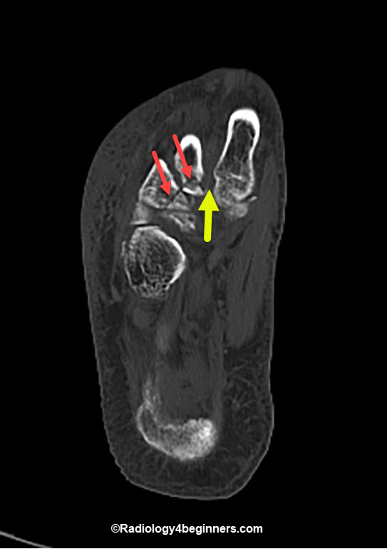 Lis Franc Fracture or Lis Franc Injury (Intraarticular Fracture at the base of the 3rd and 4th metatarsal).