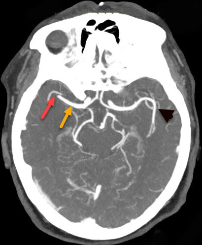 Middle Cerebral Artery Angiogram