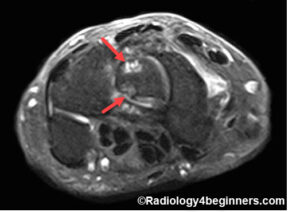 Morbus Kienböck - Radiology For Beginners By Dr. Samuel Kobba