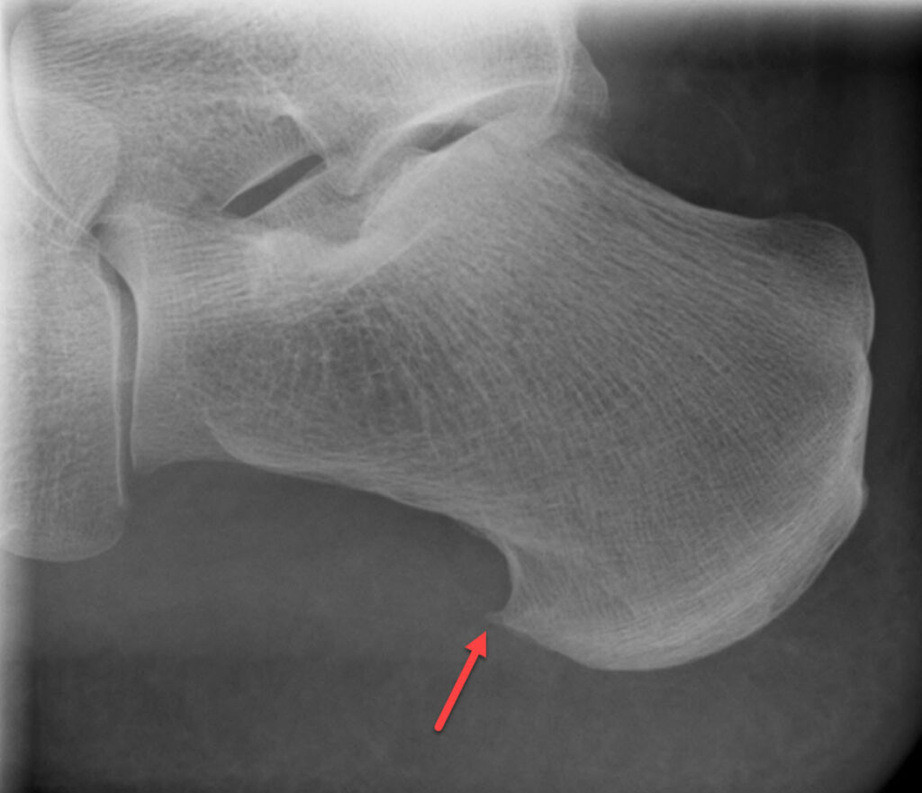 Calcaneal spur , which is the cause of the inflammation in the patient (see image below).