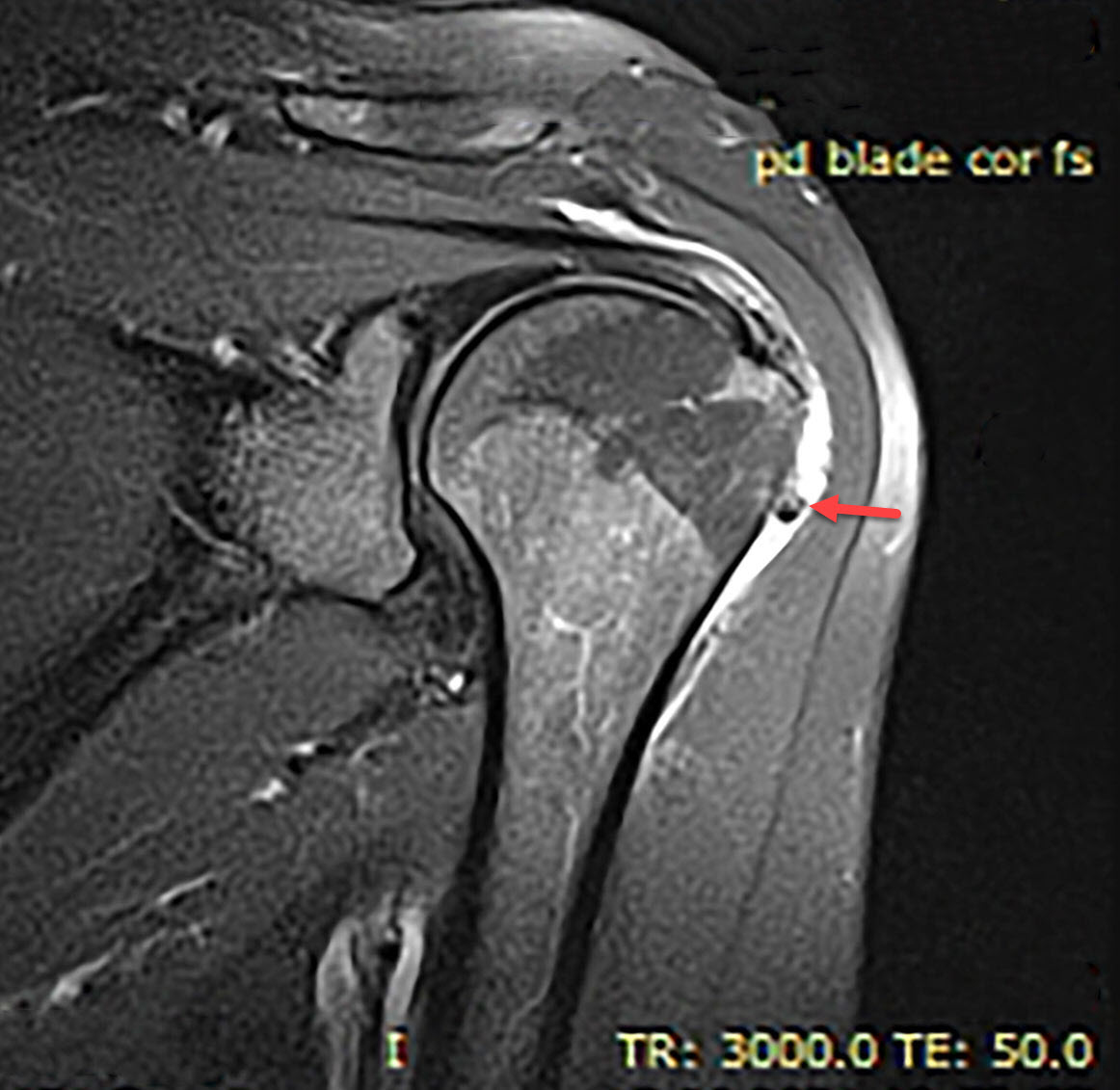 Calcific Tendinosis Radiology For Beginners By Dr Samuel Kobba 3487