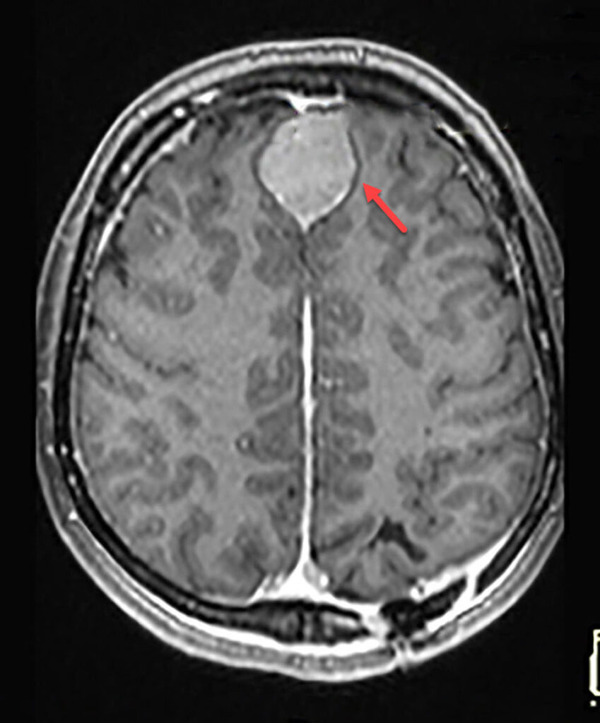 Red arrow points at a at another meningioma along the falx cerebri in the same patient, a common finding in Patients with Neurofibromatosis II