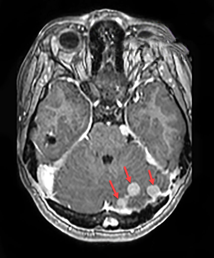 Multiple meningiomas in the cerebellum along the dura in the same patient with neuromatosis II