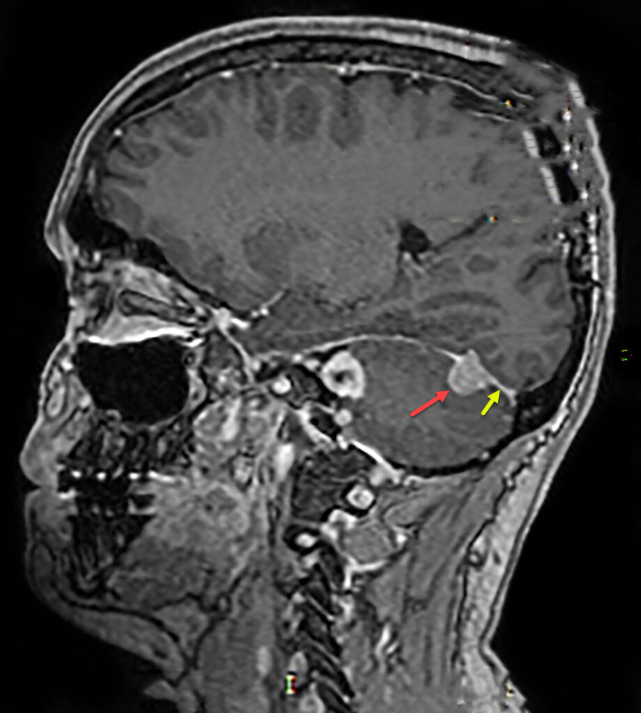 Red arrow points at a meningioma and yellow  arrow at dura mata in the same patient with Neurofibromatosis II