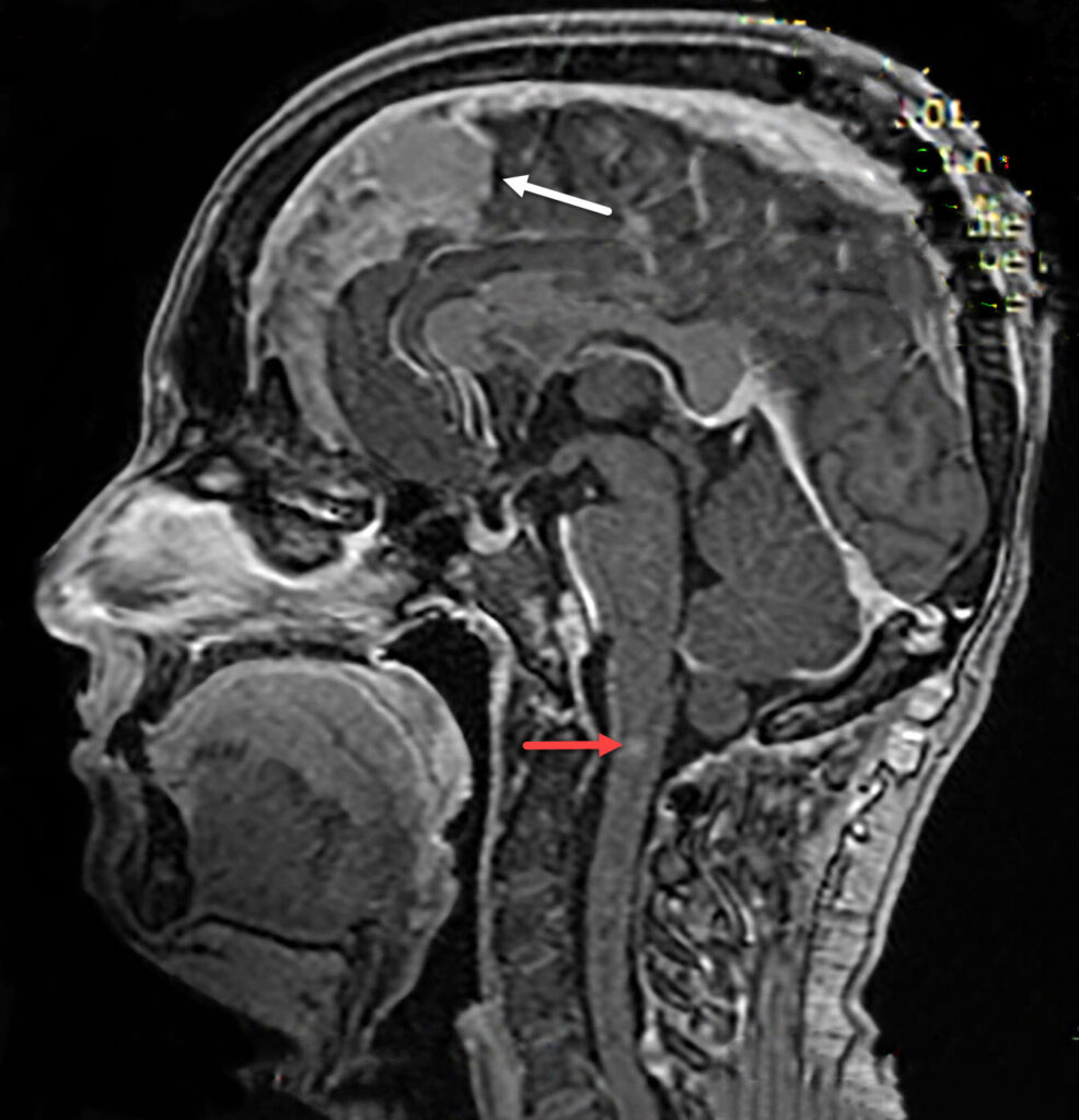 White arrow  points at another meningioma,  and red arrow at an ependymoma in the same patient with Neurofibromatosis II