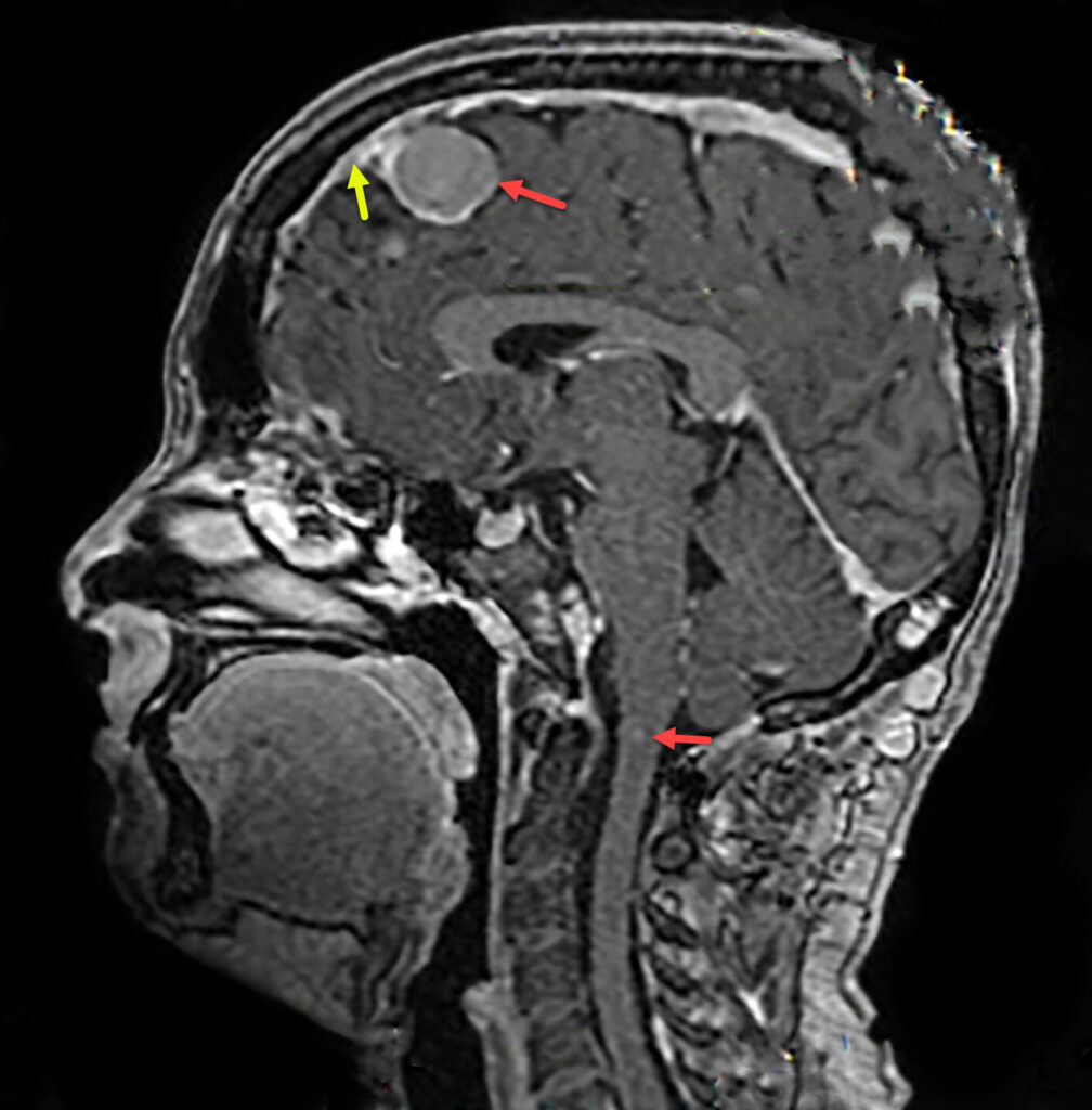 Red arrow top  points at a meningioma, yellow arrow at dura mata and bottom red arrow at  an ependymoma in the same patient with Neurofibromatosis II