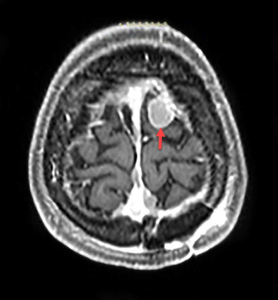 Red arrow points at a meningioma , which a common finding in Patients with  Neurofibromatosis II in the left frontal lobe