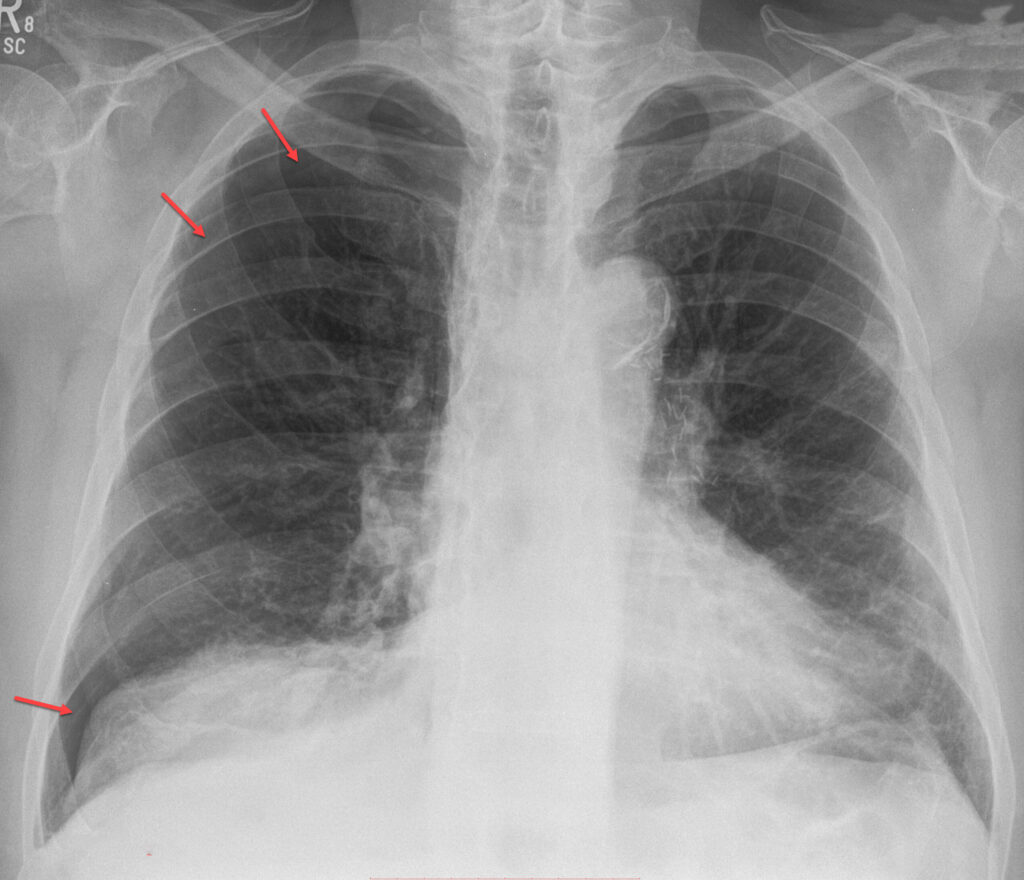 Pneumothorax -Roentgen - X-Ray