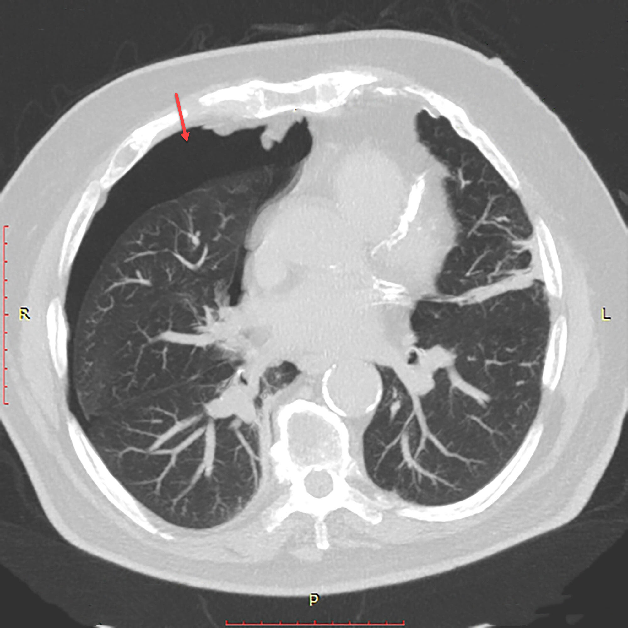 Pneumothorax Radiology For Beginners By Dr Samuel Kobba