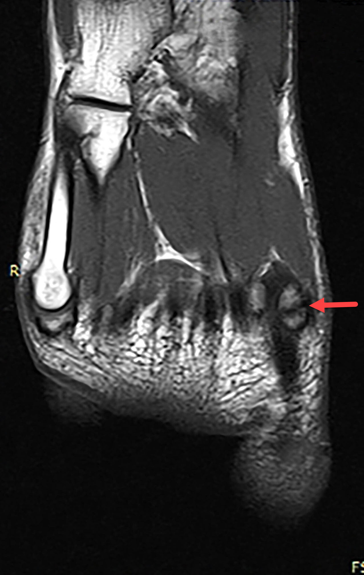 Sesamoiditis - Radiology For Beginners by Dr. Samuel Kobba