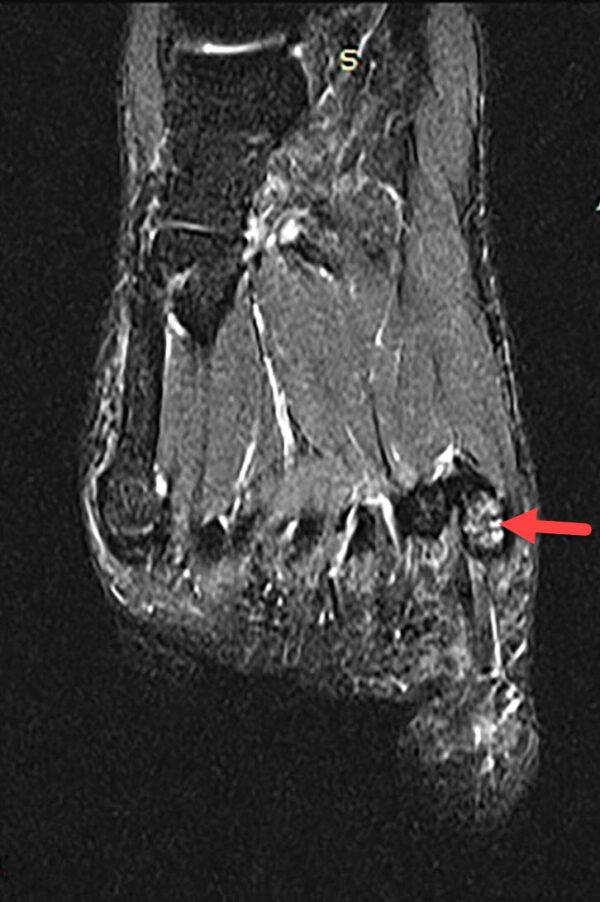 Sesamoiditis - Radiology For Beginners by Dr. Samuel Kobba