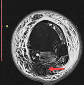 Understanding Full Thickness Achilles Tendon Rupture: Diagnosis