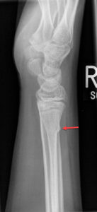 Torus (Buckle) Fracture - Radiology For Beginners by Dr. Samuel Kobba