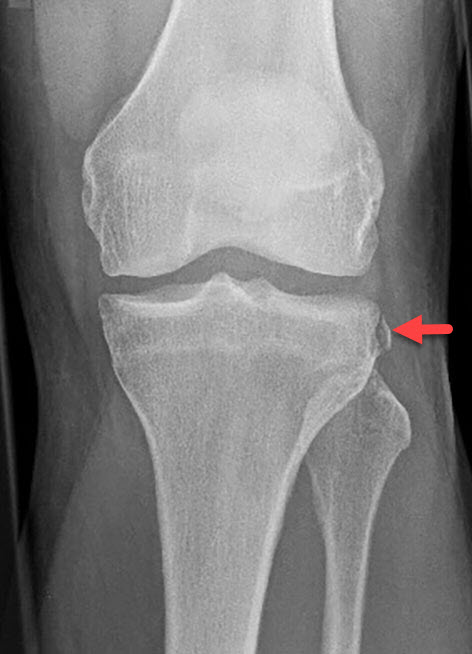 Anterior cruciate ligament tear - complete, Radiology Case