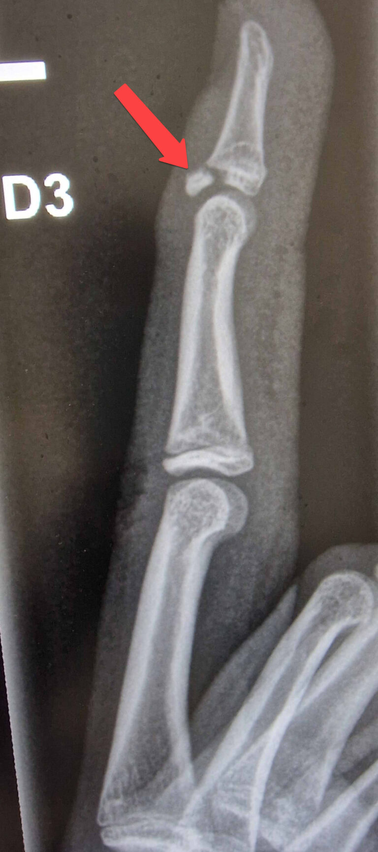 An X ray picture showing a fracture where the common extensor tendon attaches, at the end of a finger.