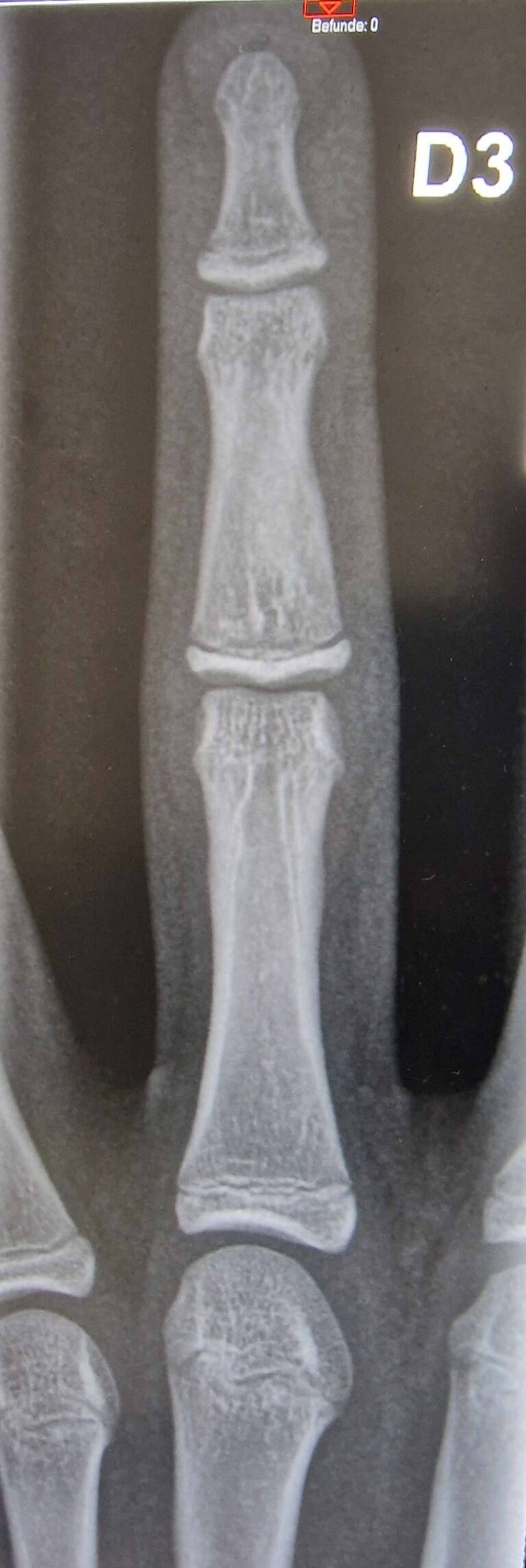 An X ray picture showing a fracture where the common extensor tendon attaches, at the end of a finger.