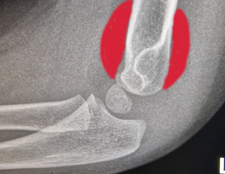 Supracondylar Fracture - Radiology For Beginners by Dr. Samuel Kobba