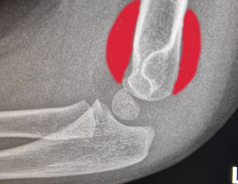 Supracondylar fracture in Children